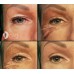 FIBROBLAST akių vokų pakėlimo bei raukšlių mažinimo plazma liftingo procedūra
